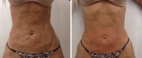 a woman's body before and after