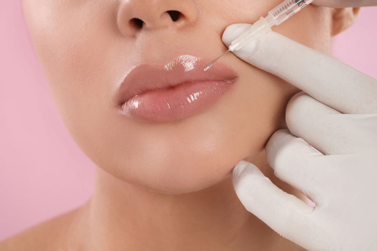 Lip Filler in Bolton