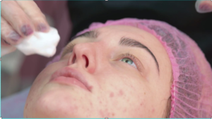 a woman with acne face
