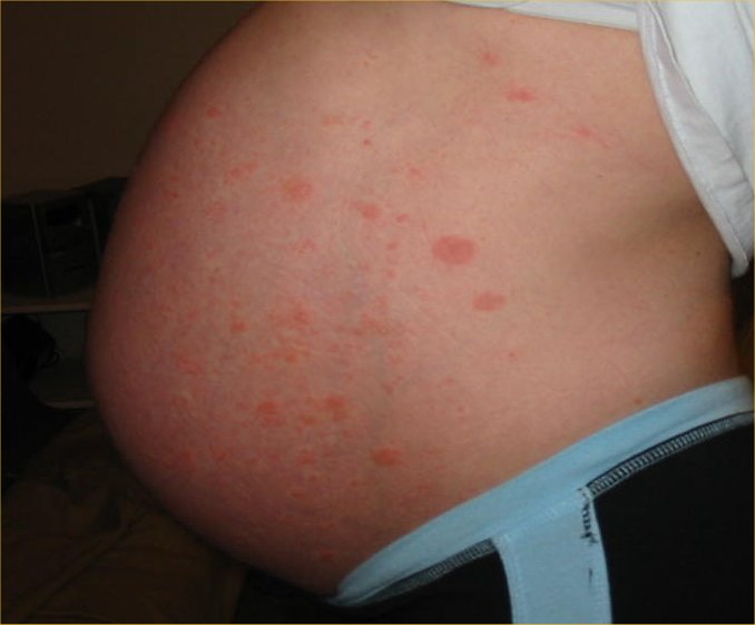 pregnant woman with a stretch mark on her belly