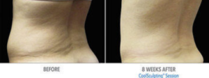 coolsculpting toronto back fat